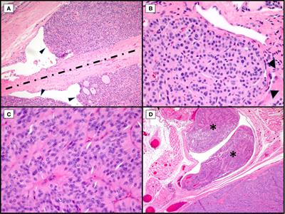 Genetics, Diagnosis, and Management of Hürthle Cell Thyroid Neoplasms